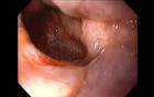 Severe Epistaxis - Case Study  (6 of 8)