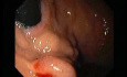 Gastric Varices - Endoscopic Ablation With Cyanoacrylate Glue (3 of 18)
