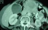 Gastric Ulcer with Gastrocolic fistula due to a Zollinger-
 Ellison Syndrome (33 of 33)