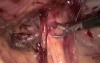 TAPP method in hernia repair