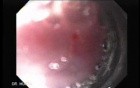 Severe Bleeding of the Upper Digestive System After Two Days of Band Ligation - Variceal Ligation, Part 1