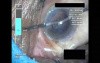 Cataract Surgery VII - Part 4