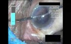 Cataract Surgery VII - Part 4