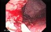 Endoscopic Resection of Giant Tubulo-Villous of the rectum (14 of 35)