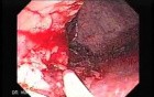 Endoscopic Resection of Giant Tubulo-Villous of the rectum (14 of 35)