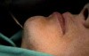 Scarless Chin Enhancement