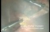 Appendectomy - Laparoscopic Approach