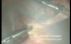 Appendectomy - Laparoscopic Approach