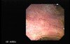 Choledocoduodenostomy and The Sump Syndrome (10 of 10)