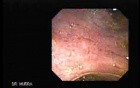 Choledocoduodenostomy and The Sump Syndrome (10 of 10)