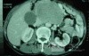 Gastric Ulcer with Gastrocolic fistula due to a Zollinger-
 Ellison Syndrome (23 of 33)