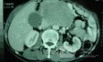 Gastric Ulcer with Gastrocolic fistula due to a Zollinger-
 Ellison Syndrome (23 of 33)