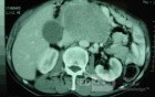 Gastric Ulcer with Gastrocolic fistula due to a Zollinger-
 Ellison Syndrome (23 of 33)