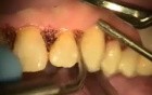 Dilantin Hyperplasia Laser Gingivectomy