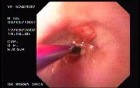 Zollinger- Ellison Syndrome - Gastric Ulcer with Gastrocolic Fistula (16 of 21)
