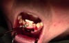 Membrane & Emdogain Applications And Bone Grafting  - Extraction #24/25 With Ridge Augmentation