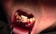 Membrane & Emdogain Applications And Bone Grafting  - Extraction #24/25 With Ridge Augmentation