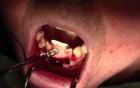 Membrane & Emdogain Applications And Bone Grafting  - Extraction #24/25 With Ridge Augmentation