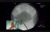 Adjustable Continence Therapy (ACT) For Refractory Stress Urinary Incontinence