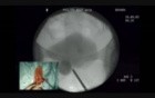 Adjustable Continence Therapy (ACT) For Refractory Stress Urinary Incontinence
