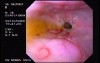 Esophageal Stricture Due To Gastroesophageal Reflux