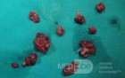 Huge Mass of the Descending Colon (24 of 25)