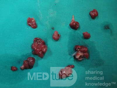 Huge Mass of the Descending Colon (24 of 25)