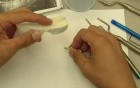 Bone Graft - Sinus Augmentation For Implant Placement
