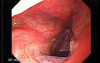 Laryngopharyngeal reflux (LPR) (2 of 2)