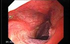 Laryngopharyngeal reflux (LPR) (2 of 2)