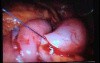 Jejunal Gastrointestinal Stromal tumor (GIST) (76 of 86)