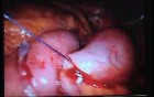 Jejunal Gastrointestinal Stromal tumor (GIST) (76 of 86)