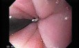 Endoscopic Baloon Dilation Of The Esophageal Stricture - Position Of The Inflated Baloon - 3/8