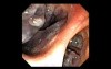 Nasopharynx (10 of 32)