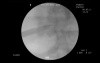 Retrograde Intrarenal Surgery - Percutaneous Nephrolithotomy