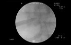 Retrograde Intrarenal Surgery - Percutaneous Nephrolithotomy