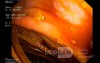 Sessile Polyp (Adenoma In The Histopathological Examination)