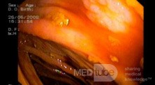 Sessile Polyp (Adenoma In The Histopathological Examination)