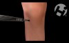 Knee Arthroscopy
