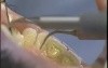 Ultrasonic Tooth Cleaning