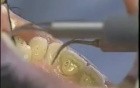 Ultrasonic Tooth Cleaning