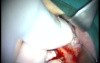 Sinus Lifting (2/2)