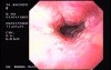 Hemorrhagic Esophagitis Due To Alcoholism - Retraction Of The Endoscope