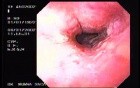 Hemorrhagic Esophagitis Due To Alcoholism - Retraction Of The Endoscope