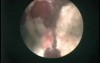 Percutaneous Nephrolithotomy - Infectious Stone