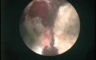 Percutaneous Nephrolithotomy - Infectious Stone