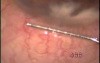 Pseudophakic Eye With Glaucoma - Microtrack Filtration