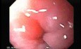 Achalasia - Endoscopic Features