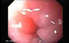 Achalasia - Endoscopic Features