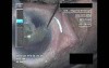 Cataract Surgery IX - Part 3